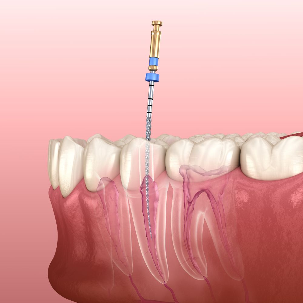 Endodonti